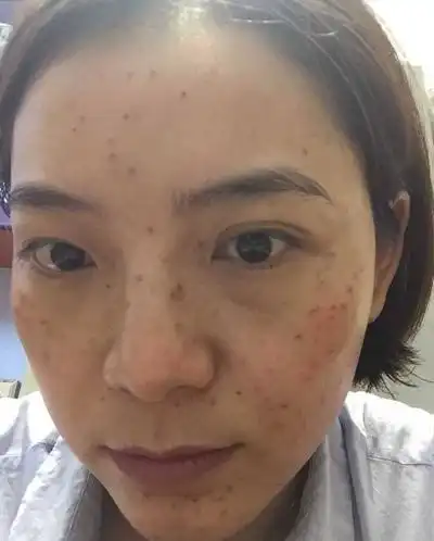 激光祛斑后反黑图片6
