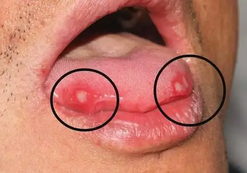 口腔溃疡90%会恶化成口腔癌,这是真的吗?