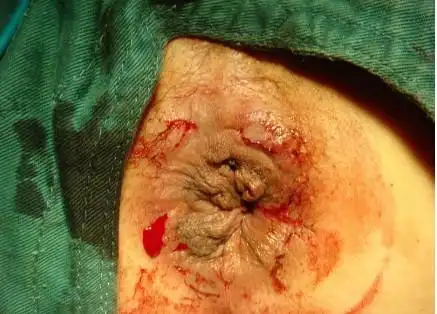 轻度的外痔疮的症状图片