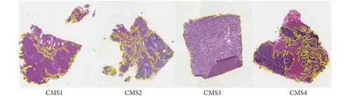 基于深度学习的结直肠癌全视野数字病理切片分子分型识别研究