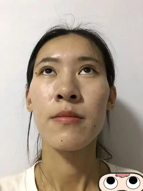 颧骨宽会显得人男性化面相,脸宽不上镜,通过一针降颧_圈子-新氧美容