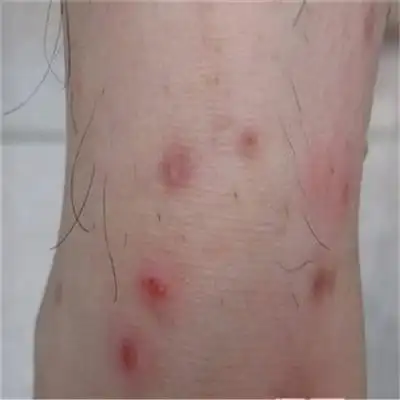 性病图片_性病症状表现图片大全_有来医生