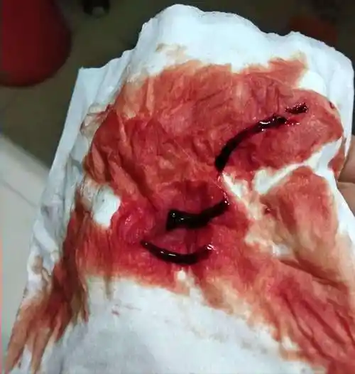 月经颜色出现黑褐色渣子,那就说明子宫循环差,动脉血液中二氧化碳含量