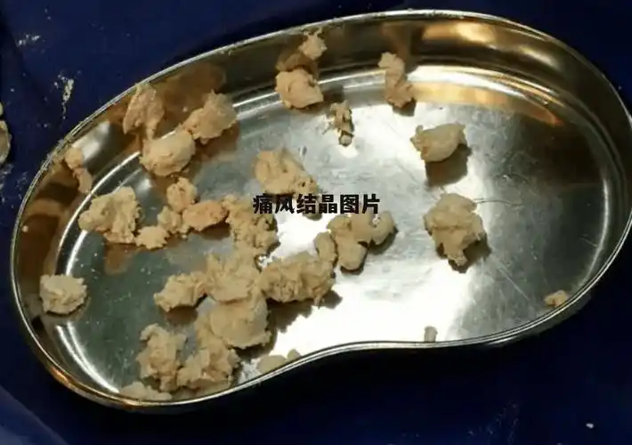 聚集去除痛风石的方法1碱化尿液碱化尿液能够将体内的尿酸盐溶解并