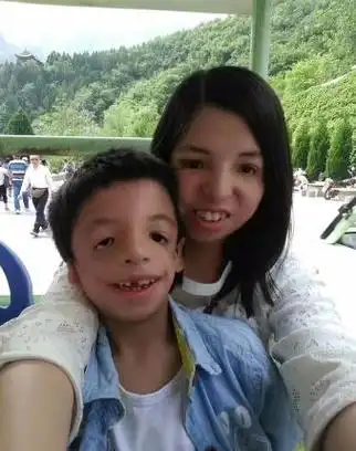男生患"鸟面综合征",常年不敢出门见人,母亲私欲是罪魁祸首