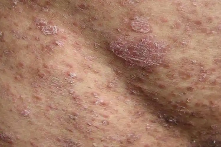 点滴状银屑病初期图片_图文_文章_美咯_让您放心美!