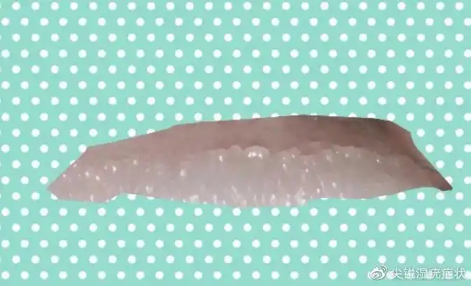 珍珠样丘疹一,珍珠疹:珍珠疹(hirsuties papillaris genitalis),又称