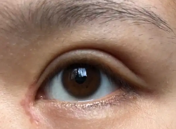 双眼皮一个月眼角增生了怎么办还红红的,也一直忌口了?