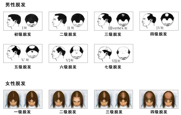 掉头发很厉害怎么办