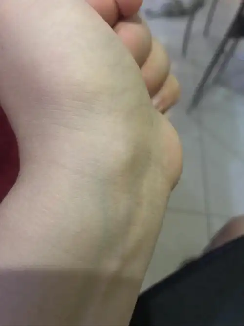 手腕内侧凸起了一个疙瘩像骨头该怎么办呜呜呜