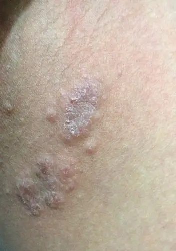 男,28岁,大腿内侧一到冬天穿上厚裤子就会长出一小片小疙瘩,有一点痒