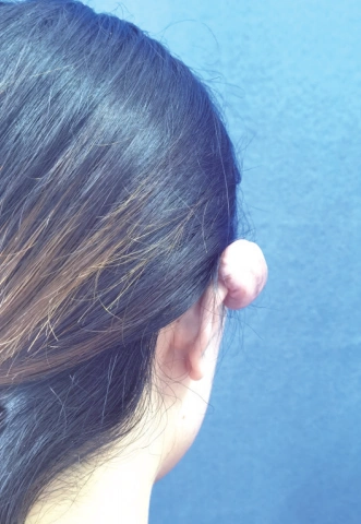 小媛耳朵上长出疙瘩.