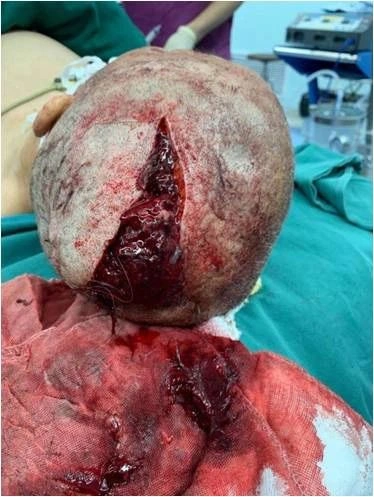 从过去简单的脑外伤清创到现在脑部肿瘤和重度颅脑损伤救治地开展,有