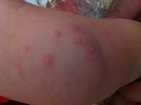 问:宝宝打完水痘疫苗,第三天凌晨发烧39.