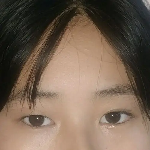 眼睛不对称很奇怪该做什么手术