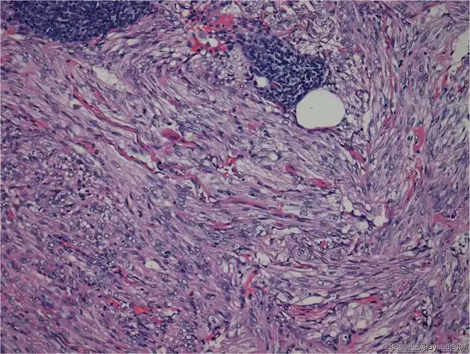 淋巴结里的梭形细胞,是什么?