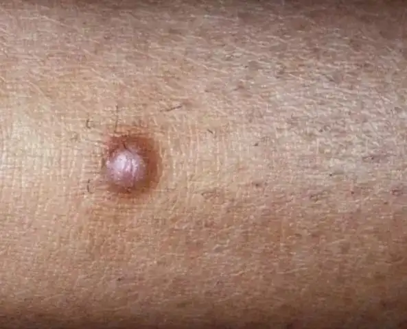 皮肤科医生告诉你如何分辨身上的这些小疙瘩