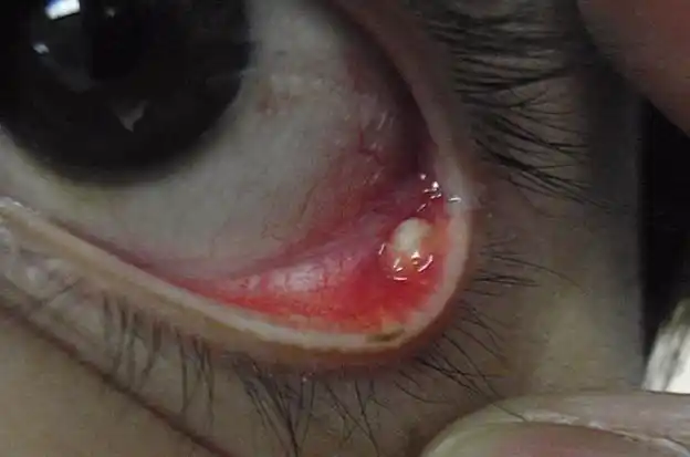 前天左边眼睛眼皮里面长了一个,白色豆粒大的东西,请问要怎么才能好?