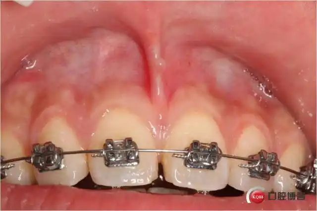 唇系带手术几岁做适合?唇系带短必须手术吗?-图片大观-奇异网