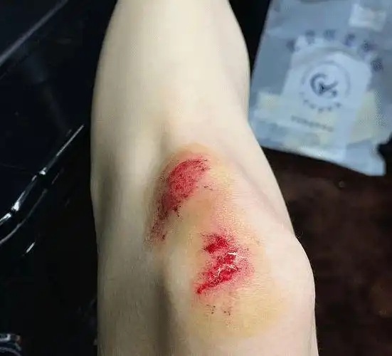 于文文深夜拍戏不慎摔倒,脸部受伤险些毁容,粉丝:看着都痛!