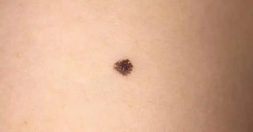 宝宝身上的黑痣会变大?出现这三种情况需注意!