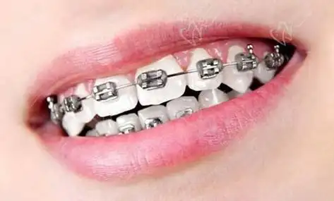 什么样的牙齿畸形需要做矫正?