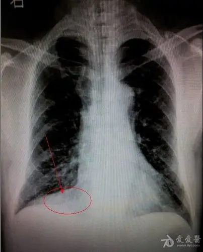 右心膈角是什么