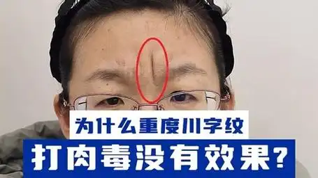 为什么重度川字纹打肉毒没有效果