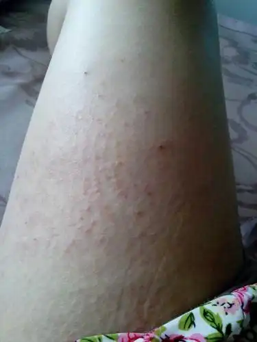 我大腿上长了一片红疙瘩,跟疹子一样平常不痒,只要一感觉热就会痒