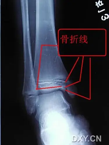 【读片】儿童踝关节,如何鉴别骨骺线与骨折 [病例帖]