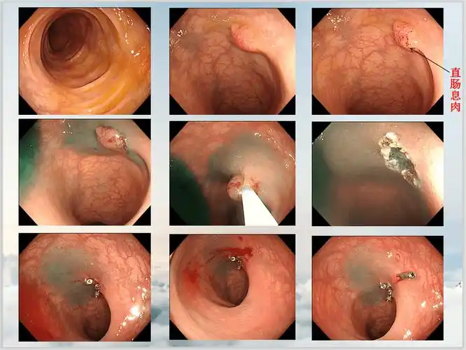 这5例肠癌都没有明显症状医生建议出现这22种情况要做肠镜检查