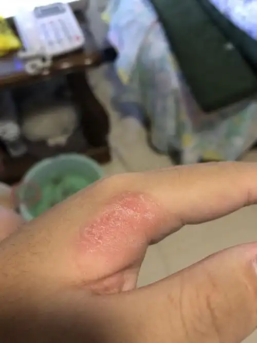 手上对称长了硬皮 有时像沟壑状的 有时就比较散 扣掉后还会再长这是