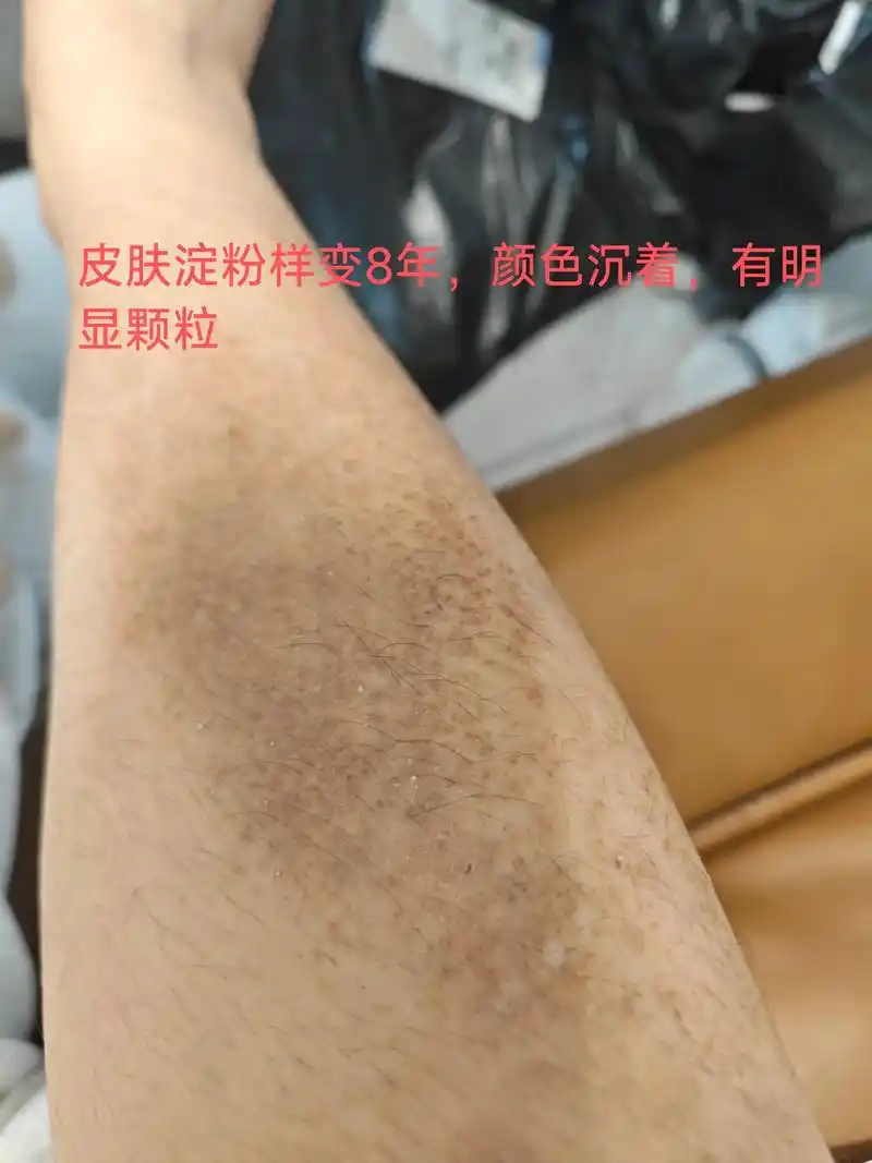 皮肤淀粉样变.#创作灵感 #抖音推广 皮肤淀粉样变,这是一个