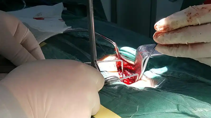 腰间盘突出微创手术典型病例介绍-范医生原创 - 好大夫在线