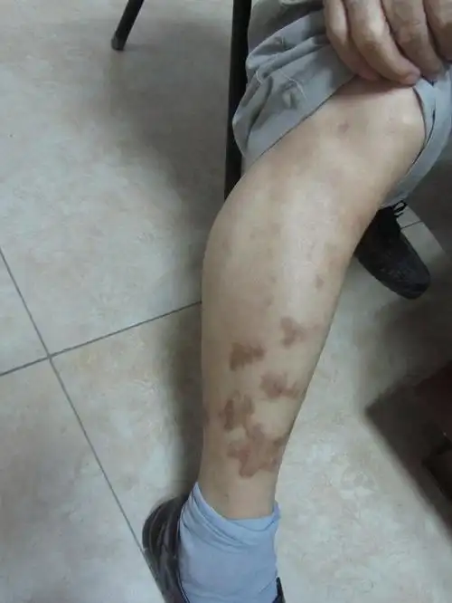 不明原因全身性血管炎,淤血导致变应性皮肤血管炎(2)