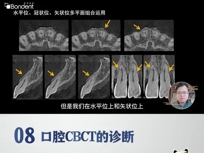 8-牙外伤-口腔cbct诊断