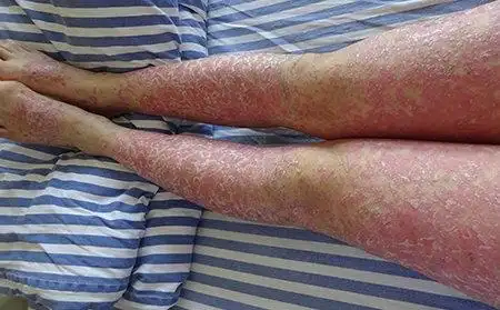 寻常型银屑病图片及症状图片_银屑病求医网