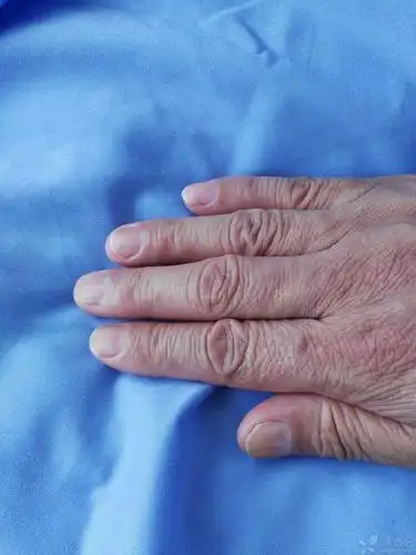 【病例讨论】指甲逐渐变黄,是甲减? [病例帖]