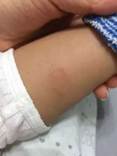 宝宝七个月,身上这个是啥?