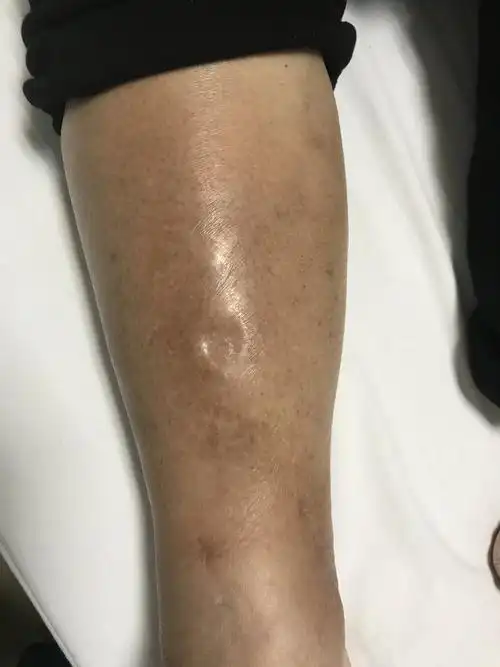 这种就是凹陷性水肿,一般不考虑深静脉血栓.