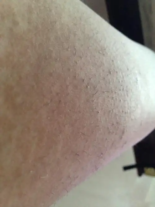 阴茎长毛囊炎的症状图片