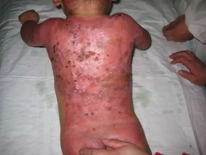 小儿大面积烧伤植皮手术前后比较1