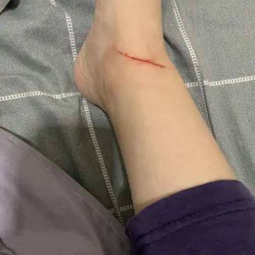 被猫抓成这样有事儿吗