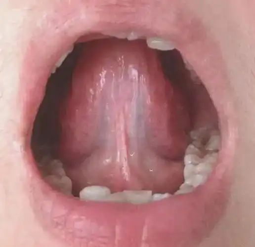 舌下络脉 - 微医(挂号网)