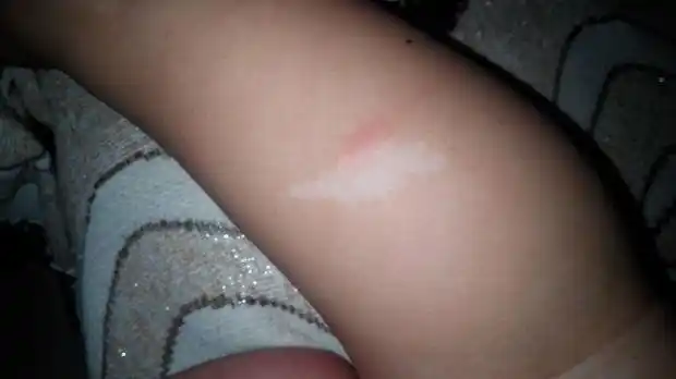 孩子出生腿上有白色胎记,能治吗?