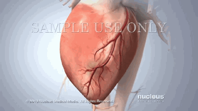 胸痛是冠心病最常见的表现,而且急性心肌梗死半数以上无先兆,大多是以