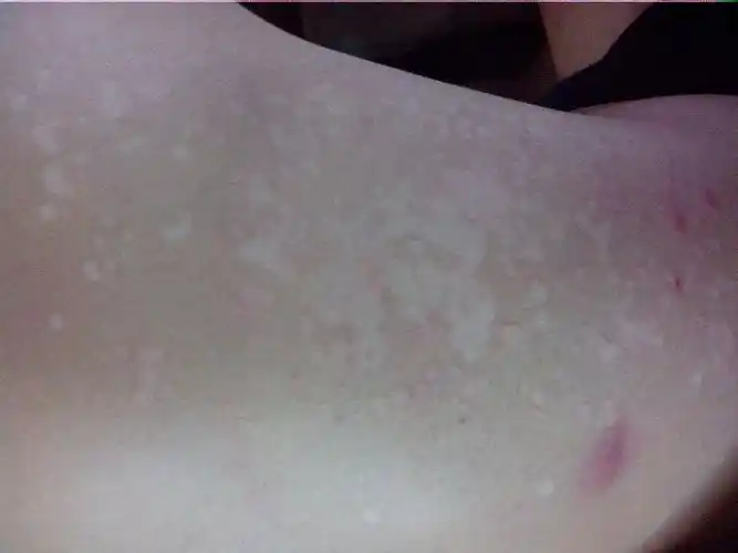 我背上长了些白色的斑点,开始只有一小点过了几个月就变成了现在这样