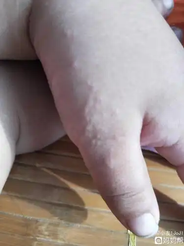 手上长了好多这样的小疙瘩,这是啥啊,?