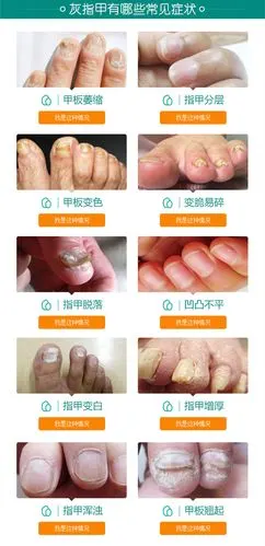 灰指甲不治疗能好起来麽?