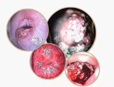 颜色和气味的改变,比如白带呈脓性,豆腐渣样,泡沫状,水样或血性等等